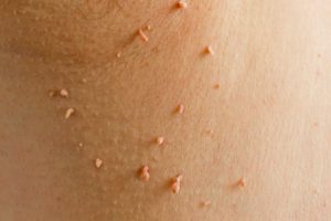 skin tags