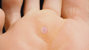 West-Berkshire-Foot-Clinic-Verruca-Treatment