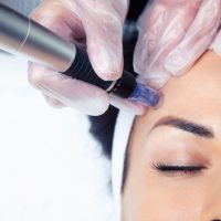 dermapen-photo